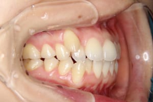 右上の犬歯が八重歯になっています